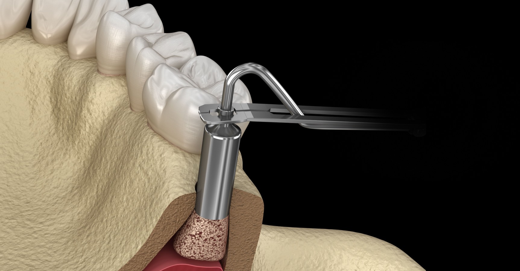 Odontopole implantologie sinus lift traitement